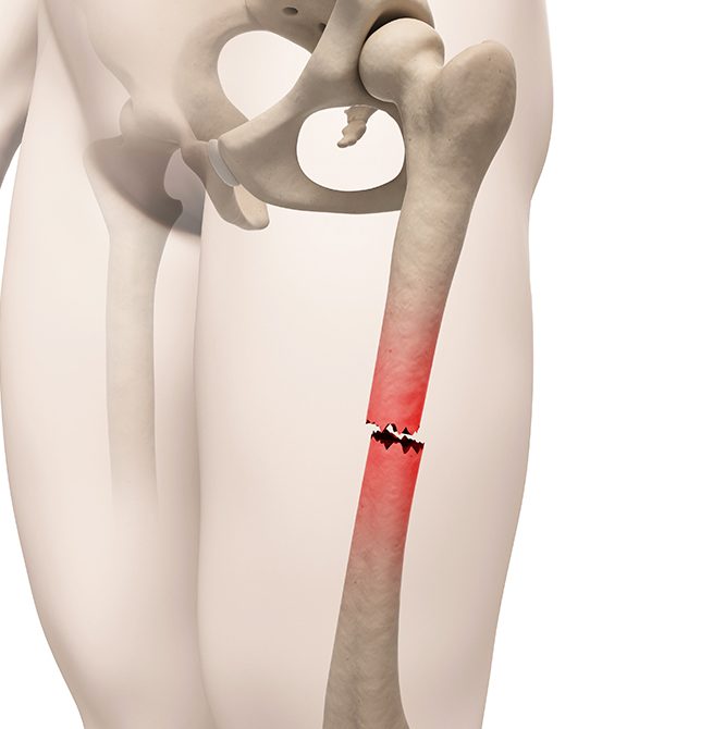 Hip Replacement Illustration